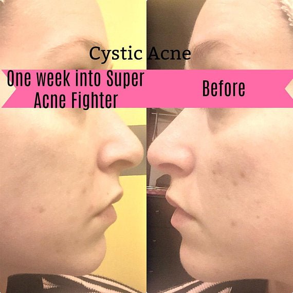 Organic Acne Treatment - Skin Tone Beauty Products